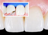 tooth bonding pireaus