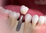implant placement