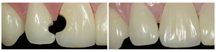 white fillings