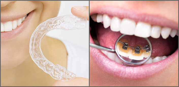 αόρατα σιδεράκια