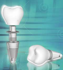 εμφυτευματα δοντιων