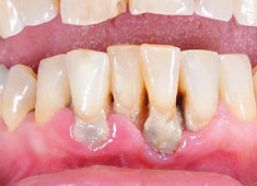 κλινική εικόνα περιοδοντίτιδας