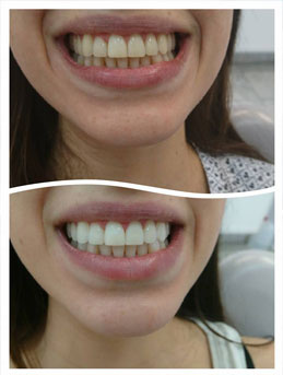 tooth whitening
