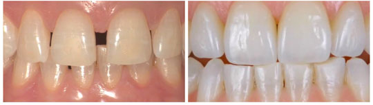 lifting στα δοντια