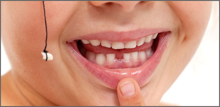 απλή εξαγωγή δοντιού