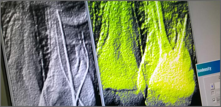 απονεύρωση οδοντιατροι πειραιας