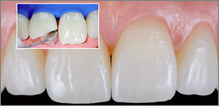 bonding δοντιών πειραια