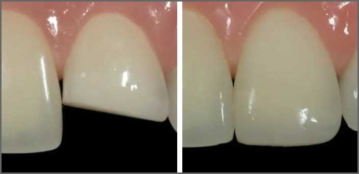 ενδειξεις για bonding