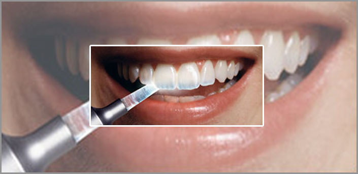 διαβρυσεων δοντιων