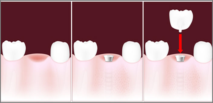 εμφυτευματα