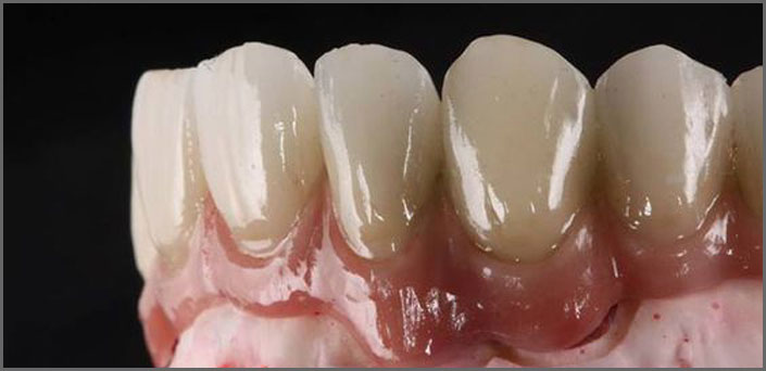 επένθετες επί εμφυτευμάτων