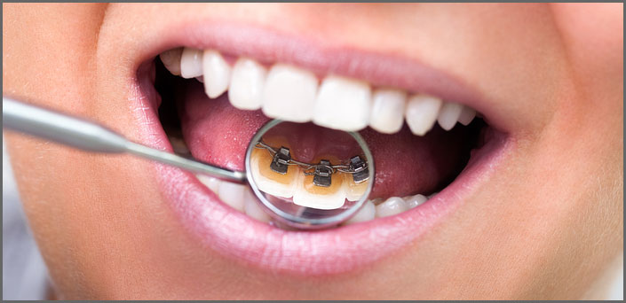 αορατα σιδερακια πειραια