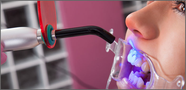 λεύκανση οδοντιατρος πειραια