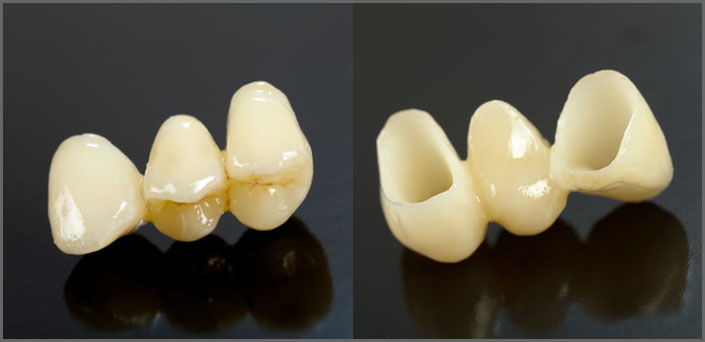 ολοκεραμικές αποκαταστάσεις δοντιων