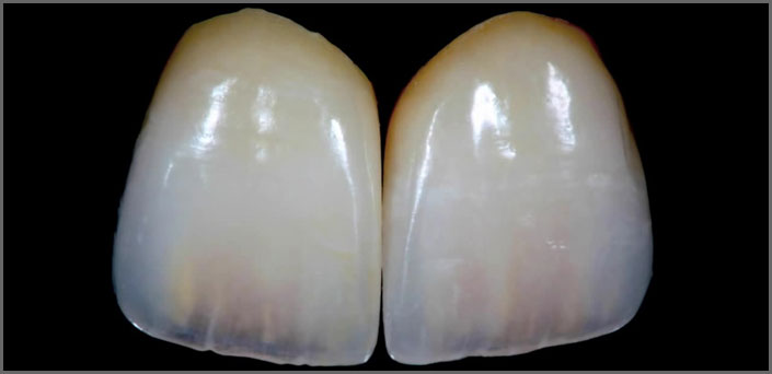 όψεις πορσελάνης - lumineers