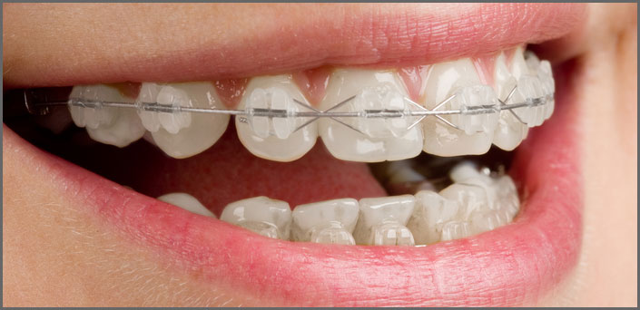 σιδεράκια κεντρο πειραια