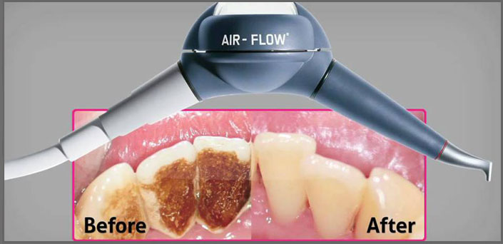 σοδοβολή οδοντιατρεια πειραια
