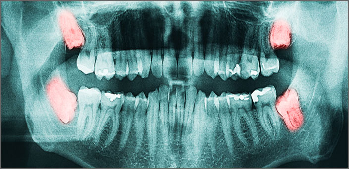 χειρουργική εξαγωγή δοντιού