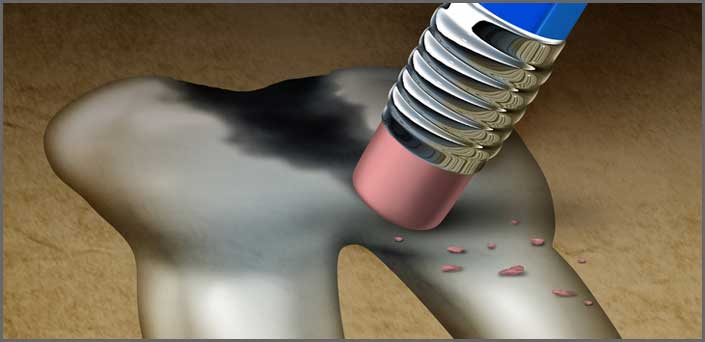 σφραγίσματα χωρίς τροχό εμφραξεις