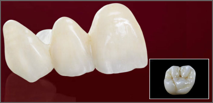 αποκαταστάσεις ζιρκονίου δοντια